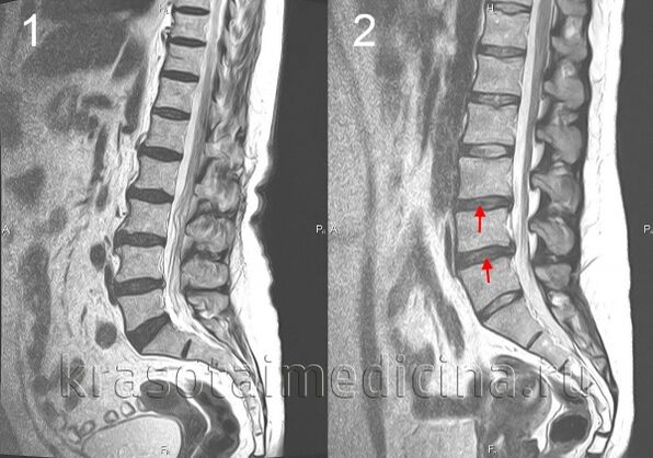 Osteocondrosi della colonna vertebrale