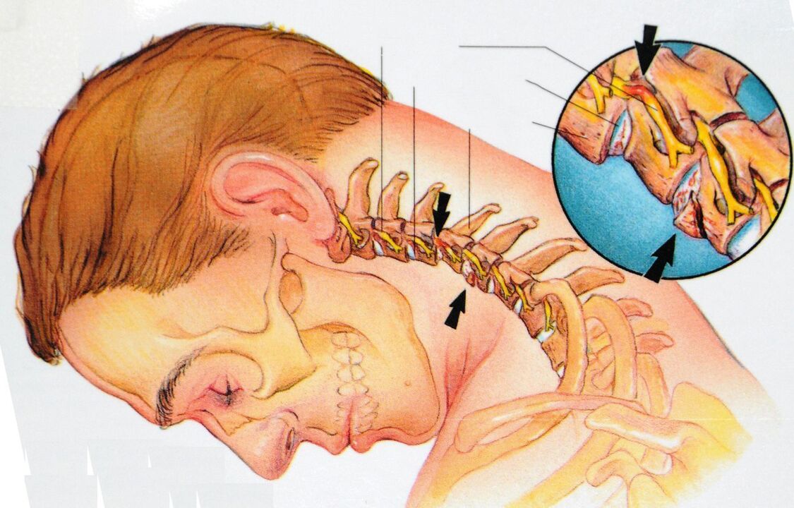 Osteocondrosi della regione cervicale