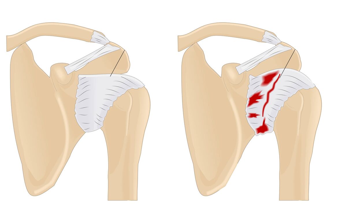 articolazione normale e colpita